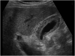 RUQUS and GB wall thickening: 4) Is there a Sono Murphys sign? -NONSPECIFIC finding!