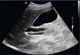 info/case list.aspx?cat=151 50 http://www.alifeatrisk.com/2012/04/does murphys sign and sonographic.html 5) Is the dilated?