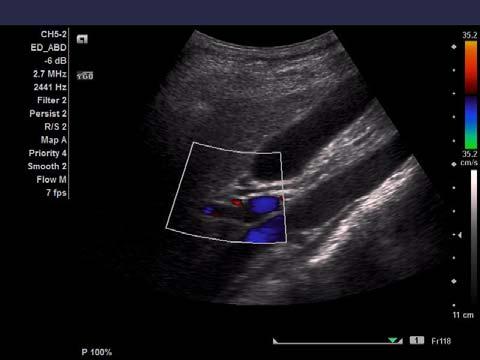 Gallbladder Portal vein QuickTime and a Animation decompressor are needed to