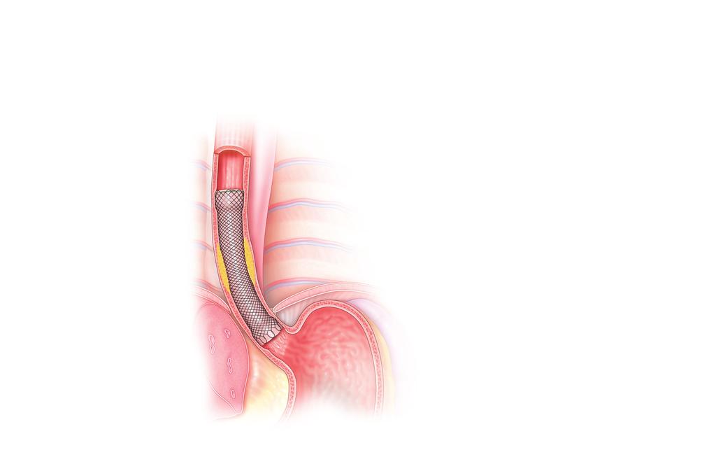 What is an esophageal stent?