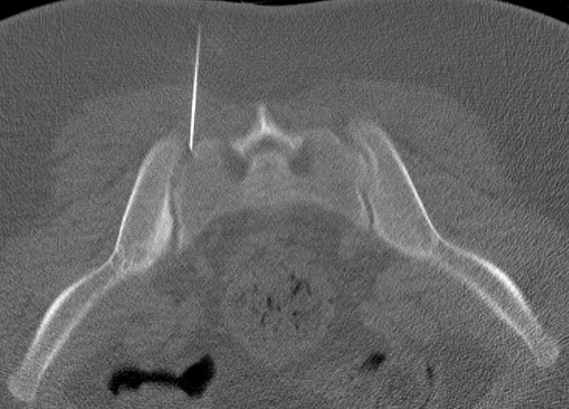 Joint fluid CT