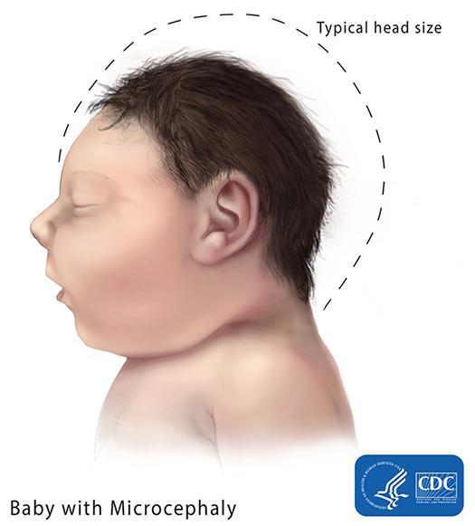Zika Virus Transmission Mosquito bite Maternal-fetal Rarely sexually transmitted Clinical Presentation Usually mild Rash, fever, arthralgia, conjunctivitis Recently linked to microcephaly, fetal