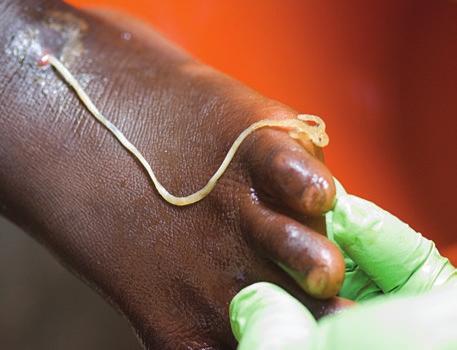 Eradication of Guinea worm has required unprecedented coordination among The Carter Center, national ministries of health, the Centers for Disease Control and Prevention, the World Health