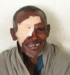 Trachoma, an infectious disease, is prevalent in poor, rural communities that lack the tools for basic hygiene, clean water, Emebet Gebre, 11, a student at Abreja Primary School in North Gondar,