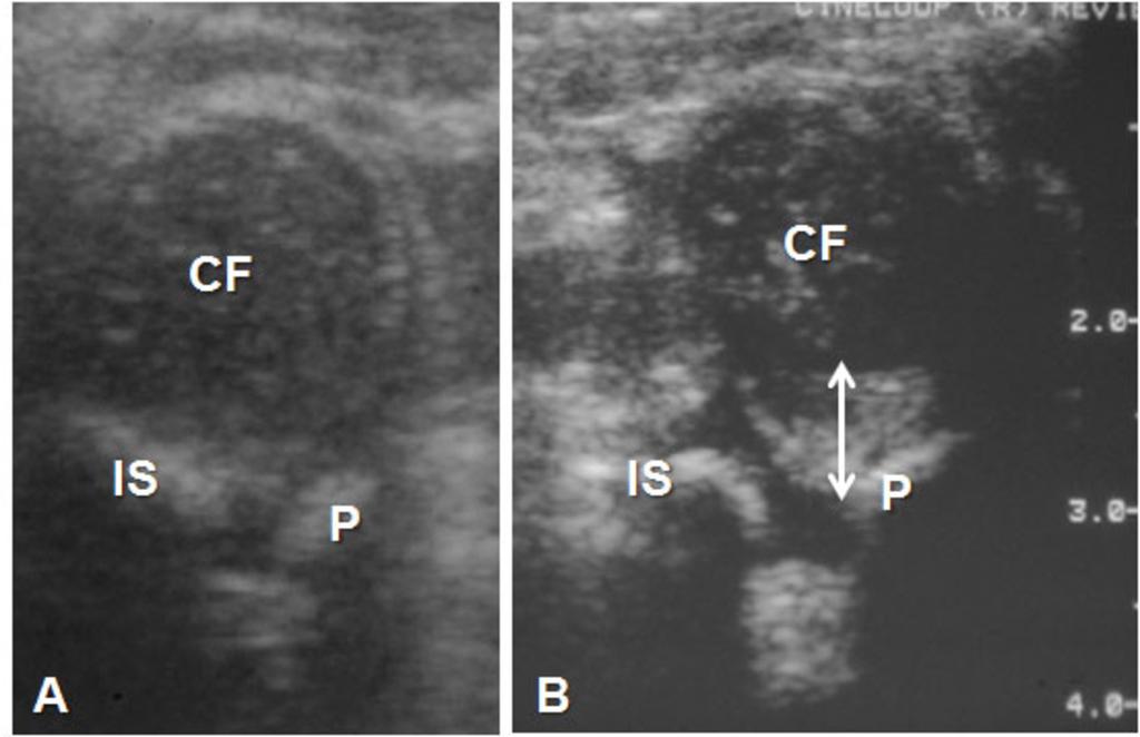 Fig. 8: A: Transverse neutral sonogram of normal hip shows the femoral