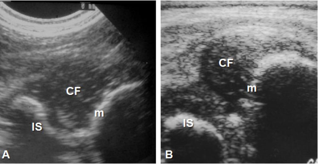 ischium (is)posteriorly; B, Sonogram of a dislocated femoral head. Fig.