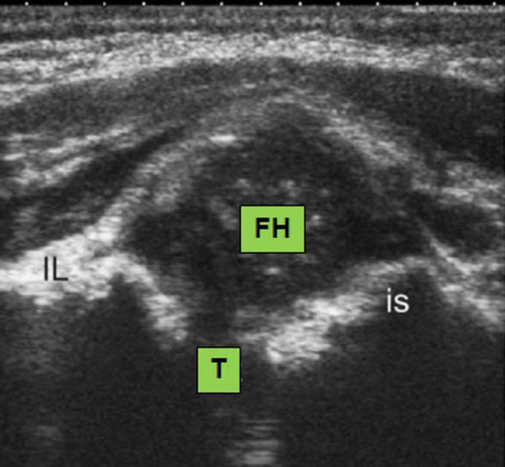 Fig. 11: Posterior lip sonogram of a dislocated hip