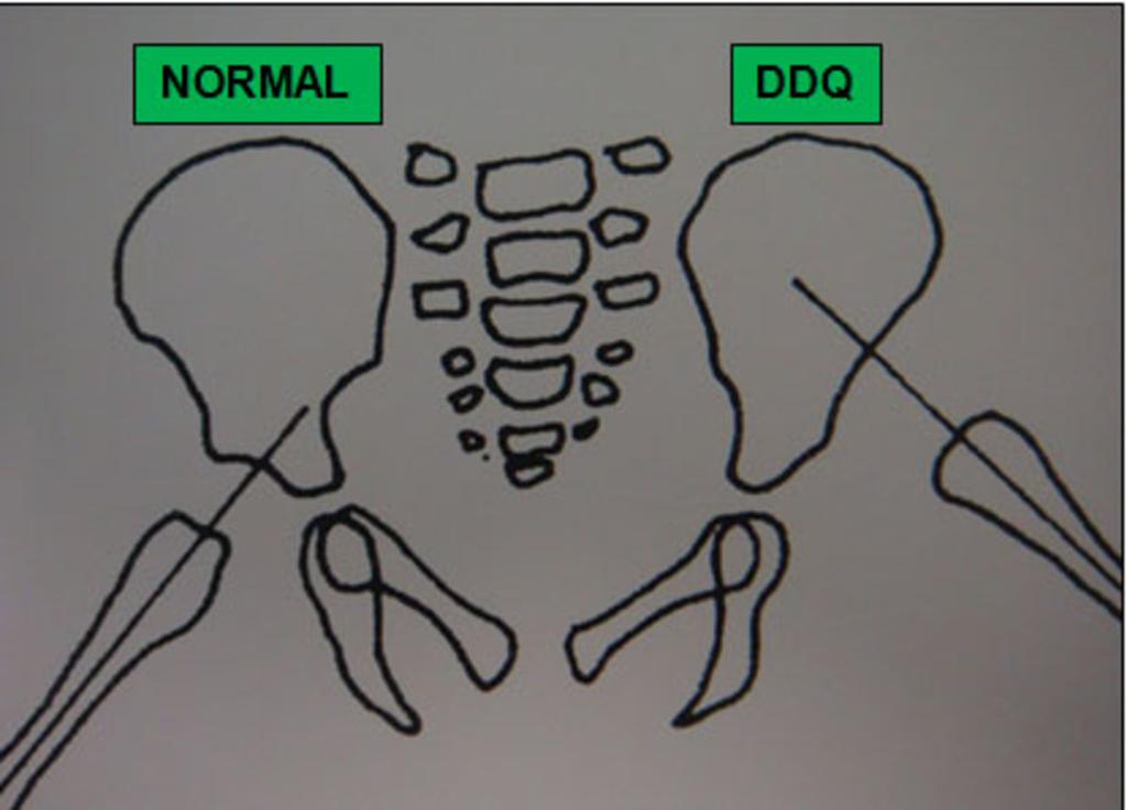 Fig. 1: Diagram in the frog-leg position showing dislocation of