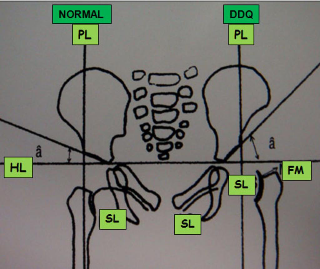 Fig. 2: Diagram showing the lines and the acetabular index used to assess the developing hip.