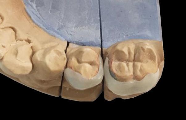 No systemic diseases or drug allergies were noted. Intraoral examination revealed an approximately 3 mm spacing between the mandibular left second premolar and second molar.
