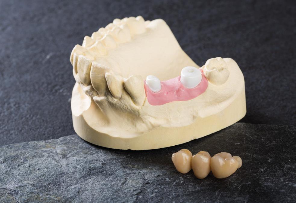 Due to its hardness, the dialog Vario Occlusal applied to the framework of creates an accurate likeness to the natural
