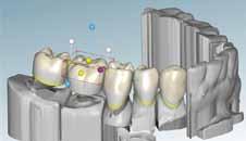 tooth-borne restorations Innovative materials deliver esthetics combined with an efficient production a