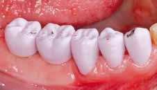 max CAD crowns in positions 43 47 (43 45 tooth-borne, and 46 + 47 implant-borne restorations) via