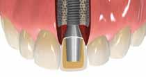 Straumann CARES abutments The customized solution for your implant restorations Implant abutments create the sensitive transition from the osseointegrated implant through the peri-implant soft tissue