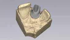 2 Laboratory Design the customized Straumann CARES Abutment in Straumann CARES