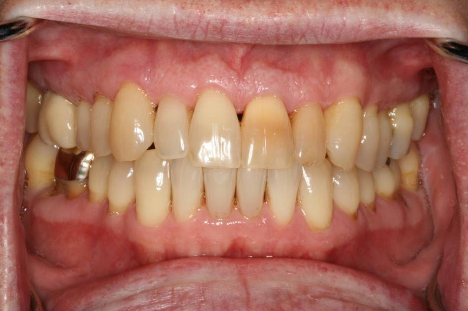 Minimal and No-prep Veneers Good arch form and axial contours for using a no-prep approach.