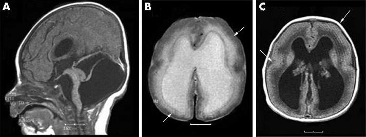 Electronic letter 3of5 Figure 2 The brain MRI of patient 2 (LP97 123) at 3 days shows diffuse agyria with a thick 1 cm cortex (arrows in C), discontinuous laminar heterotopia just beneath the cortex