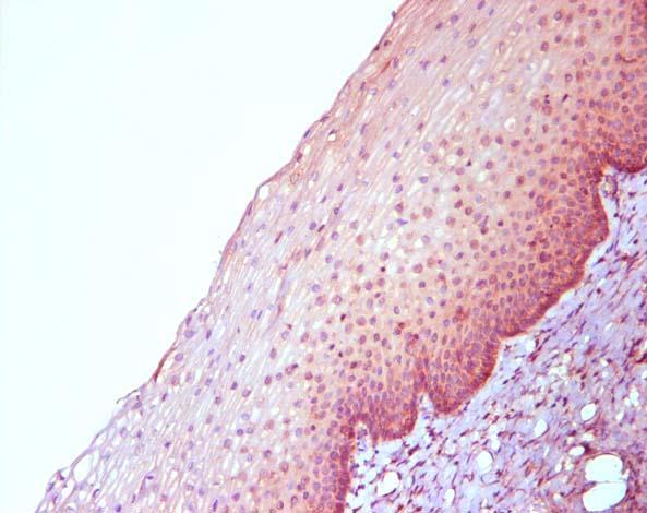 Epithelial microabrasion and wound healing are necessary for HPV infection cervix vagina vulva penile shaft peri-anal skin Microtrauma to the epithelium exposes the basement membrane to which HPV