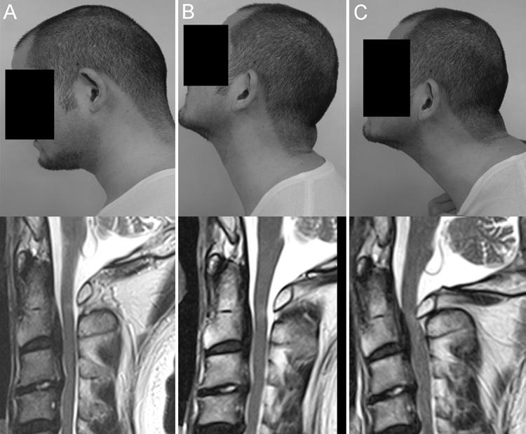 Upper cervical cord compression by a C-1 posterior arch Fig. 3. Sagittal T2-weighted MR images (lower row) and corresponding head positions (upper row).