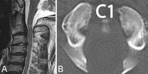 C: The spinal cord compression at the upper cervical level caused by the C-1 posterior arch was evident in a protruded-head position, which included the patient extending his jaw.