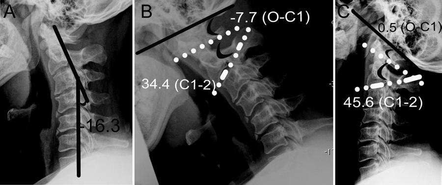 M. Takeuchi et al. Fig. 5. Postoperative lateral radiographs showing the kyphotic alignment under C-2. A: The Cobb angle (C2 7) was 16.3. B: Dynamic flexion radiograph showing angles of 7.