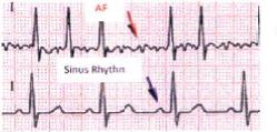 What is Atrial Fibrillation We just learned that the heart stays in sinus rhythm because the electrical signal telling it to beat comes from only one place - the Sinus Node In some people, other