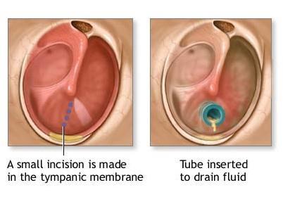 Otitis Media Middle ear inflammation Result of sore throat Especially in children Shorter, more horizontal pharyngotympanic