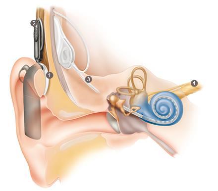 Treating Deafness Cochlear implants for congenital or age/noise cochlear damage Convert sound energy into