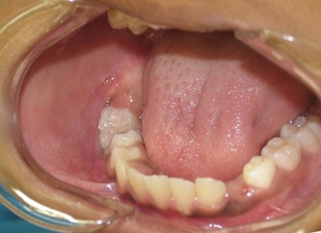 INTRODUCTION Central giant cell lesions (CGCLs) are rare benign intraosseous proliferative lesions that corresponds to fewer than 7% of all benign maxillary lesions.