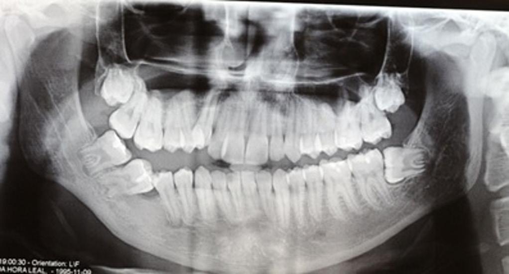 Figure 5. Eight-year radiographic control, showing regression of the lesion with evidence of new bone formation and complete root development of the 45 and 47 dental units. has low recurrence rate.