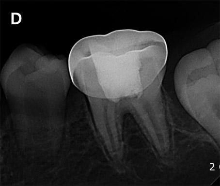 Two cases are presented in which PRF was used as pulpotomy material to treat carious pulp exposure in immature permanent teeth. Ⅱ.