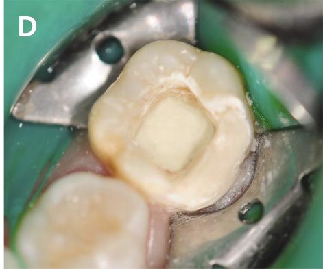 An approximately 2 mm thick layer of MTA (ProRoot, Dentsply Tulsa Dental Specialty, Tulsa, OK, USA) was placed over the PRF (Fig. 3D).