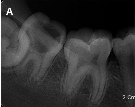 Case 2 Ⅲ. Discussion A 12-year-old girl was referred from a local clinic due to caries control of the right mandibular second molar.