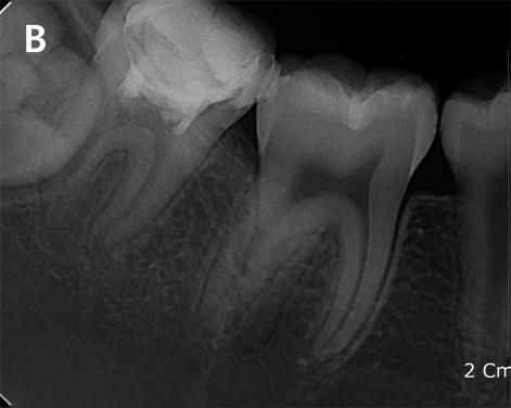 Periapical radiograph revealed deep caries invading the pulp and open apexes of the right mandibular second molar (Fig. 4A). The patient also complained of intermittent pain.