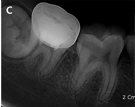 The patient had no pain or discomfort, and glass-ionomer cement was placed over the MTA. After 1 month, a crown was placed on the right mandibular second molar.