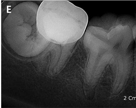 Carious pulp exposure in immature teeth causes irreversible damage to the pulp tissue and arrests root development, which can negatively influence the long-term prognosis of tooth retention 11).