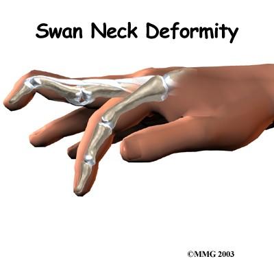 Swan neck deformity=== (DIP