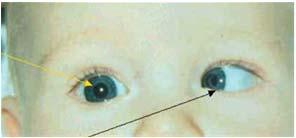 Light reflexes in the same place for each eye. OD: Note that light reflex falls on center of pupil.