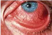 Conjunctiva and Sclera Disorders Conjunctivitis