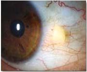cornea Viral = clear discharge, contagious