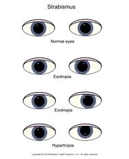 imbalance in the activity of the EOM s. Strabismus Strabismus can be subtle or obvious, intermittent or constant.