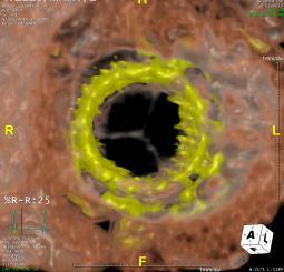 Follow Up Imaging Short Axis 4D CTA No thrombus is seen on the