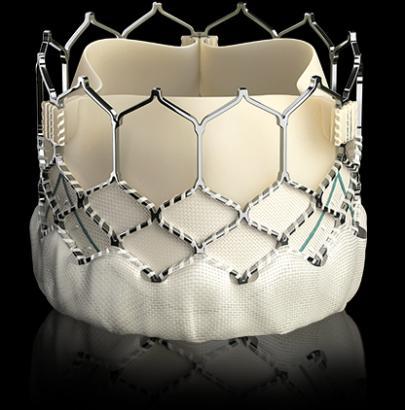 Epiphany: TAVR in MAC TAVR seats into calcified annulus Balloon mounted TAVR devices have a relatively low profile