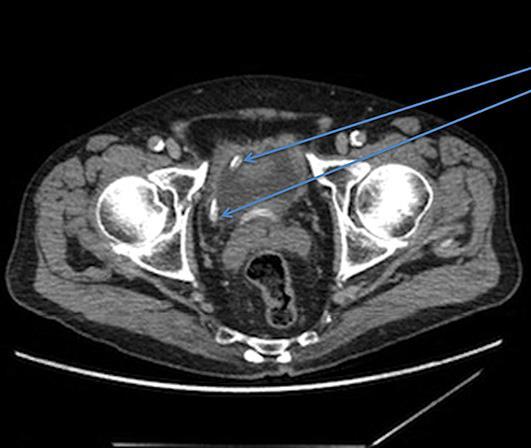81 Fig. 2. CT section showing PD catheter in the bladder. Table 1.