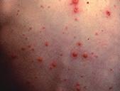 Chickenpox (varicella) is a viral infection caused by the varicellazoster virus. Shingles (herpes zoster infection) is caused by re-activation of the chicken-pox virus.