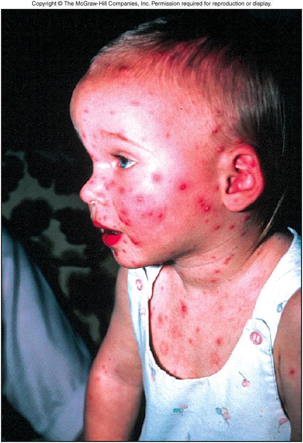Chicken Pox Popular name for varicella One of the most common rashes among children Incidence declined