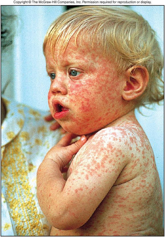 Measles - Rubeola A.k.