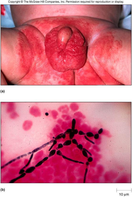Superficial Cutaneous Mycoses Symptoms Some colonized