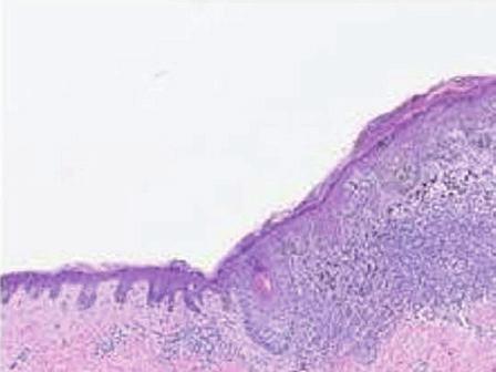 Diagnostic terms given No of pathologists MPATH-Dx class I Common nevus, junctional Dysplastic nevus - mild Halo nevus () Atypical melanocytic neoplasm, junctional (suggested treatment of no further