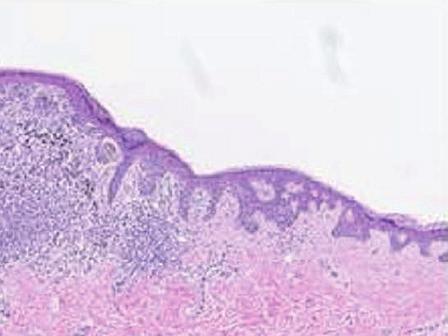 nevus not otherwise specified, including atypical nevus of special anatomic - moderate Atypical intraepithelial melanocytic proliferation (AIMP) (suggested treatment of repeat excision <5 mm margins